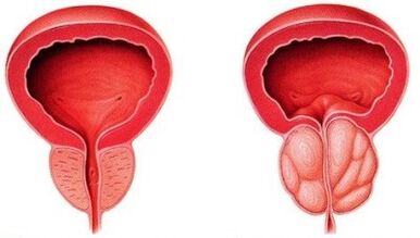 prostata sana e infiammata con prostatite
