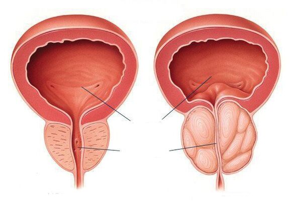 normale prostata e infiammazione della prostata